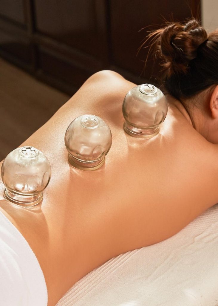 cupping therapy Melbourne