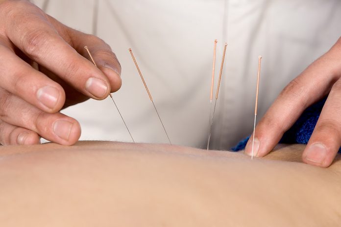 Dry needling physio