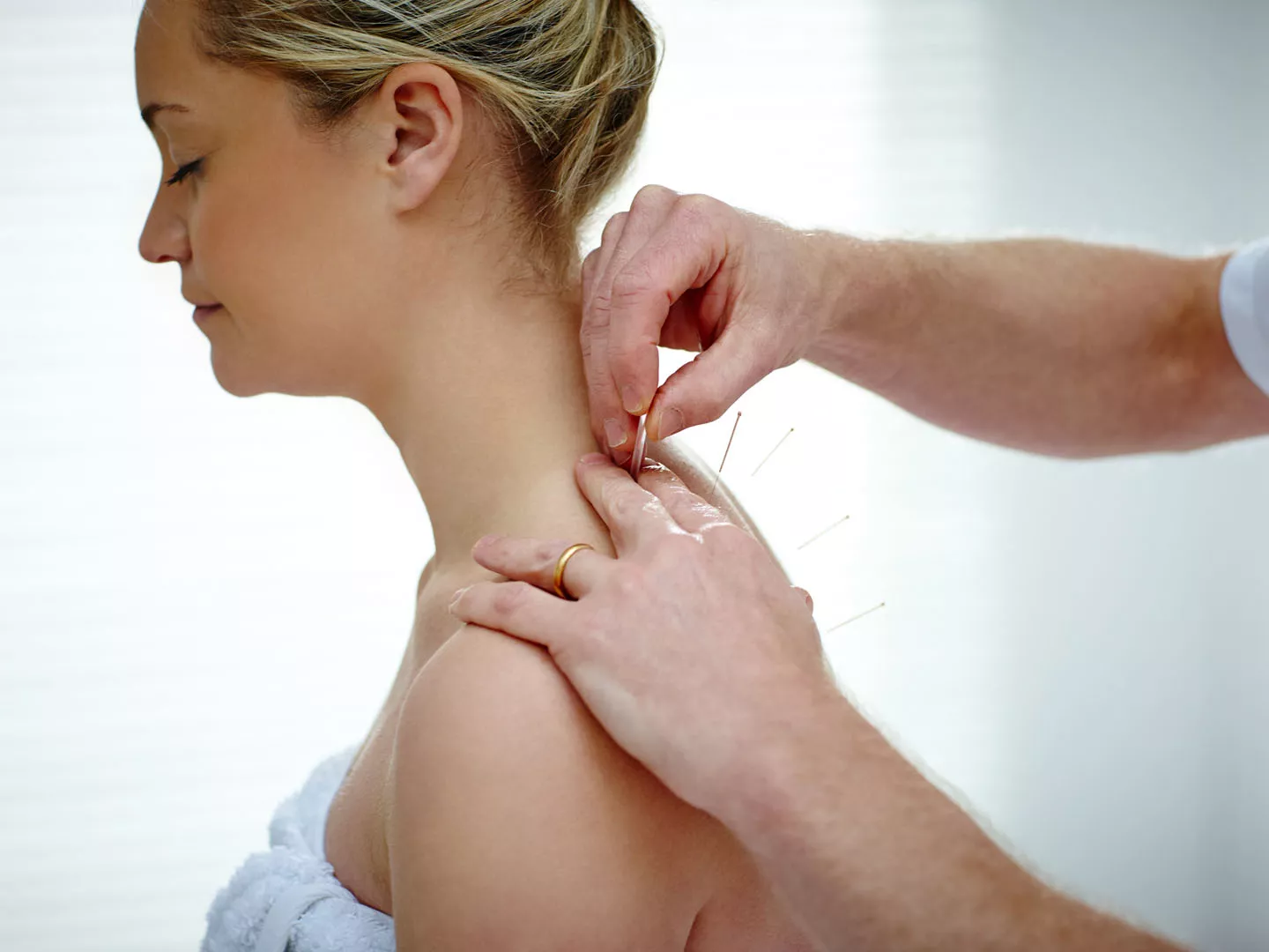 Dry needling physio