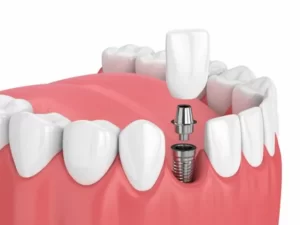 Dental Implant