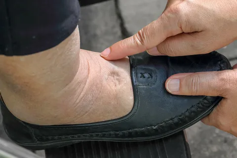  best shoes for edema