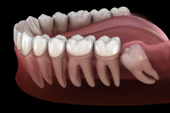 wisdom teeth