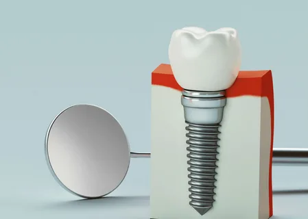 Dental implants Mascot