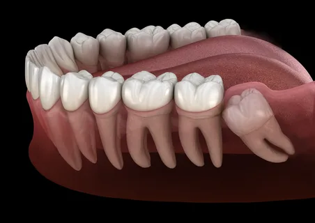 Wisdom Teeth Removal Enmore