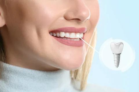 Dental Implants Alexandria
